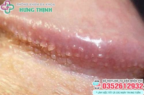 Cậu nhỏ nổi mụn trắng không ngứa không đau