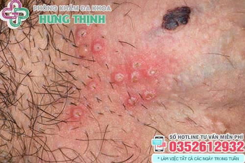 Hình ảnh nổi mụn bọc ở thân dương vật