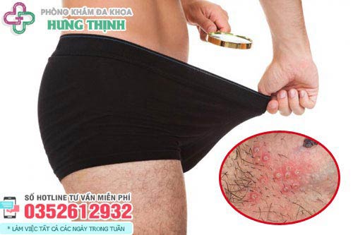 Nổi mụn bọc ở thân dương vật là bệnh gì?