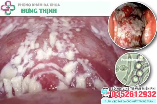 Cách chữa khí hư màu trắng đục có mùi hôi