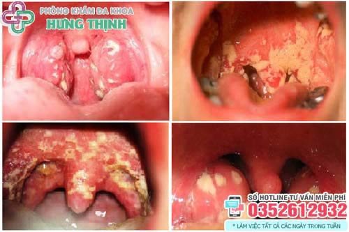 Triệu chứng bệnh lậu ở miệng, họng