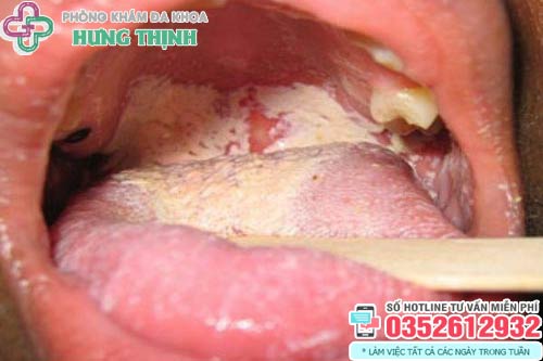 Dấu hiệu bệnh lậu ở miệng, họng