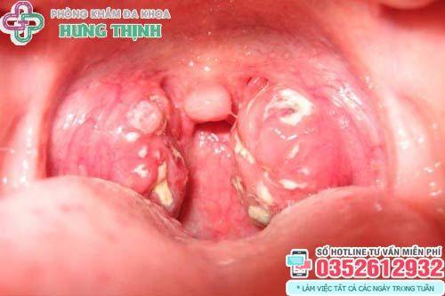 Cách chữa bệnh lậu ở miệng, họng