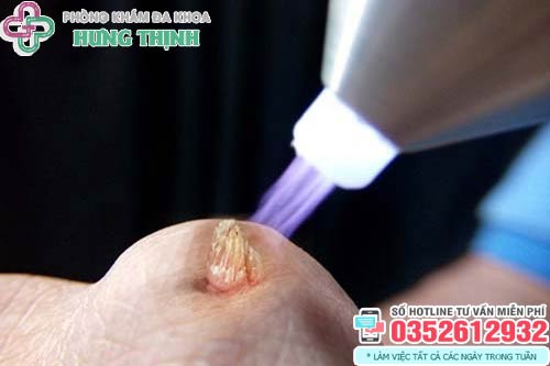 Đốt sùi mào gà