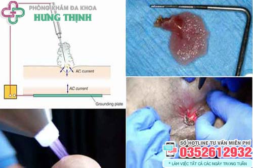 Đốt sùi mào gà bao lâu thì khỏi