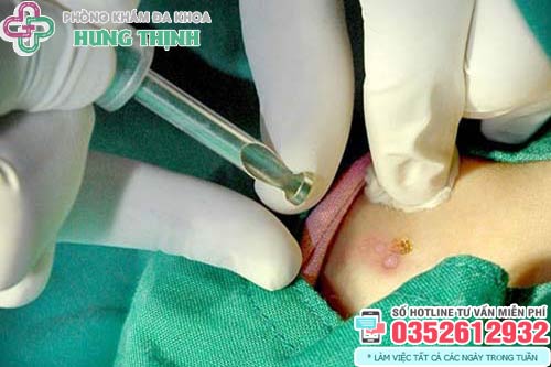 Đốt sùi mào gà có tái phát không