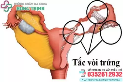 Chữa tắc vòi trứng ở đâu tốt Hà Nội
