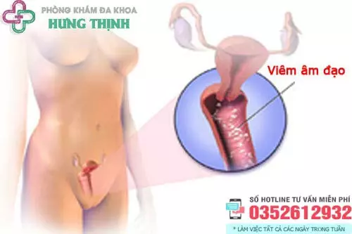 Bệnh viêm âm đạo là gì?