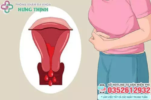 Biểu hiện của rong kinh ở phụ nữ