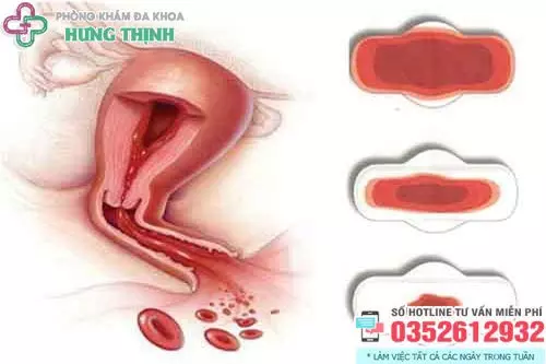 Bị rong kinh phải làm sao?