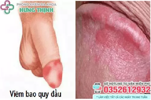 Viêm bao quy đầu khám ở đâu