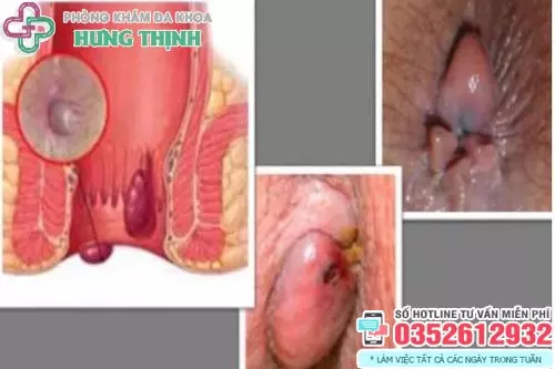 Hình ảnh bệnh trĩ hỗn hợp