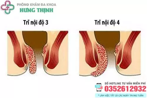 Hình ảnh bệnh trĩ độ 3, 4