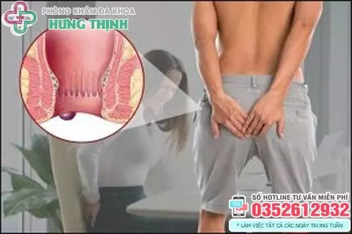 Hình ảnh bệnh trĩ