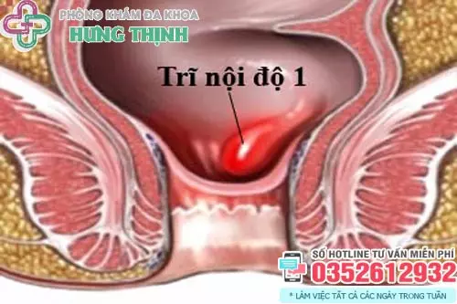 Hình ảnh bệnh trĩ giai đoạn đầu