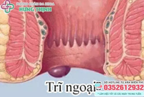 Hình ảnh bị trĩ ngoại