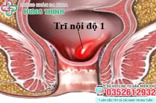 Hình ảnh trĩ nội độ 1