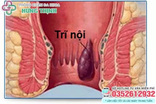 Cách trị trĩ nội độ 1