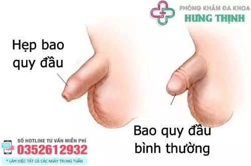 Hẹp bao quy đầu là gì?