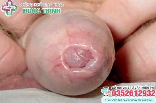 Dấu hiệu bị hẹp bao quy đầu ở trẻ