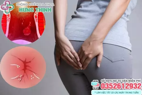 Hình ảnh ngứa hậu môn