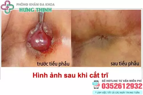 Hình ảnh sau khi cắt trĩ