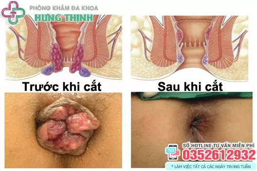 Hình ảnh trước và sau khi cắt trĩ