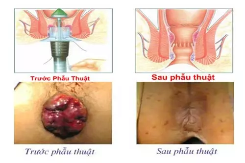 Hình ảnh hậu môn sau khi cắt trĩ