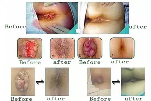 Hình ảnh trước và sau cắt trĩ