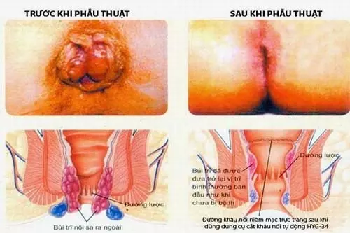 Hình ảnh sau phẫu thuật cắt trĩ