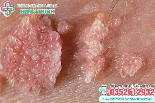 Bệnh sùi mào gà là gì?