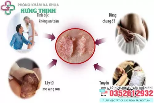 Bệnh sùi mào gà lây qua những đường nào?