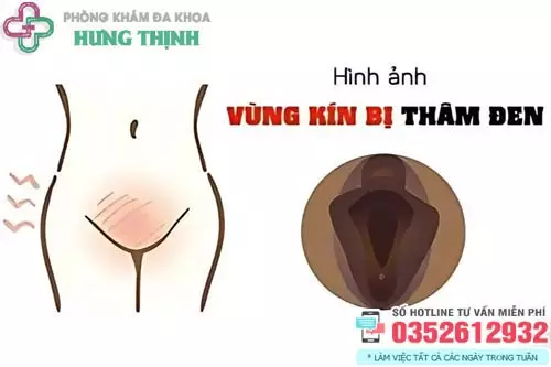 Hình ảnh cô bé bị thâm đen