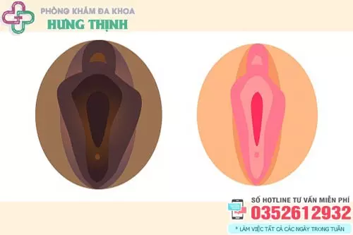 Hình ảnh vùng kín thâm đen