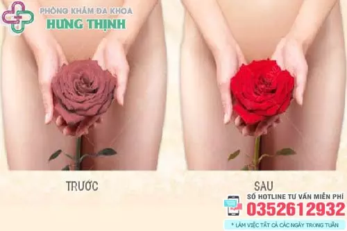 Cách khắc phục vùng kín bị thâm đen