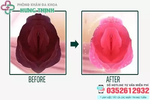 Cách khắc phục vùng kín bị thâm đen