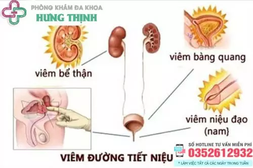 Bệnh viêm đường tiết niệu