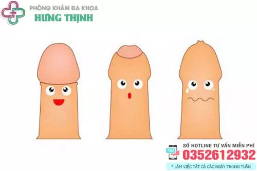 Cắt bao quy đầu