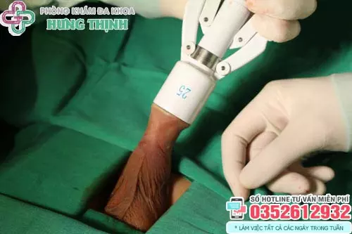 Khi nào nên cắt bao quy đầu