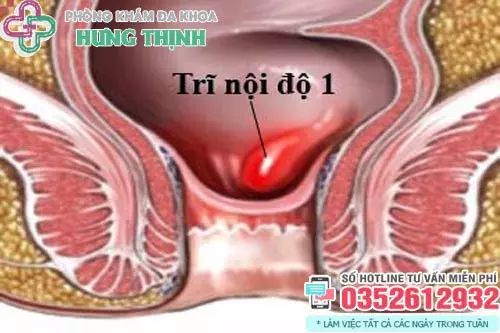 Cách chữa bệnh trĩ nội