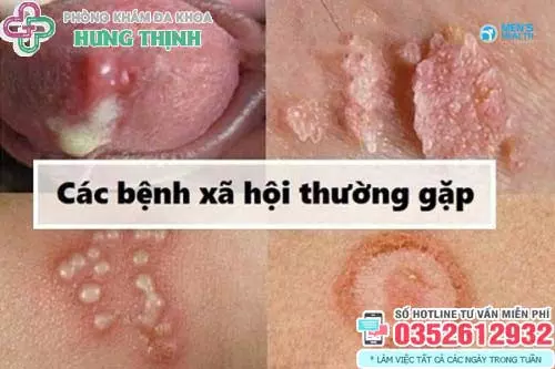 Xét nghiệm bệnh xã hội ở đâu Hà Nội