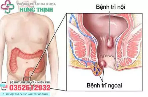 Chữa bệnh trĩ ở đâu tốt nhất