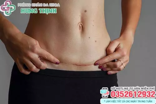 Sau sinh mổ bao lâu thì quan hệ được