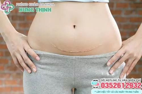 Sinh mổ bao lâu thì được quan hệ vợ chồng