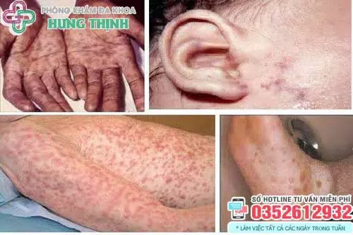 Bệnh giang mai có chữa khỏi được không?
