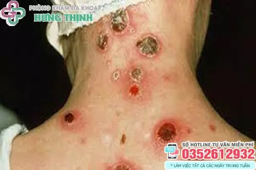 Bệnh giang mai có chữa được không?