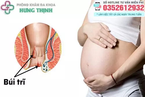 Bệnh trĩ có đẻ thường được không?