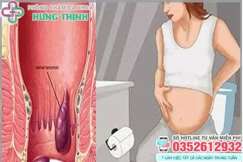 Bệnh trĩ có sinh thường được không?