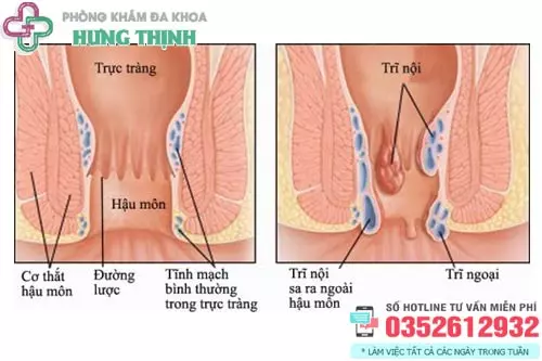 Hình ảnh hậu môn bình thường và hậu môn bị trĩ