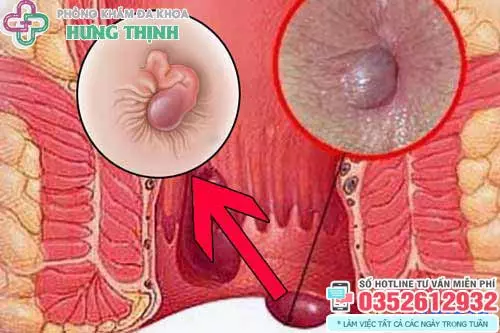 Cách chữa bệnh trĩ